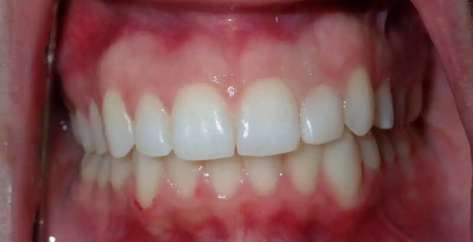 A close-up of a person's teeth showing healthy gums and well-aligned teeth.