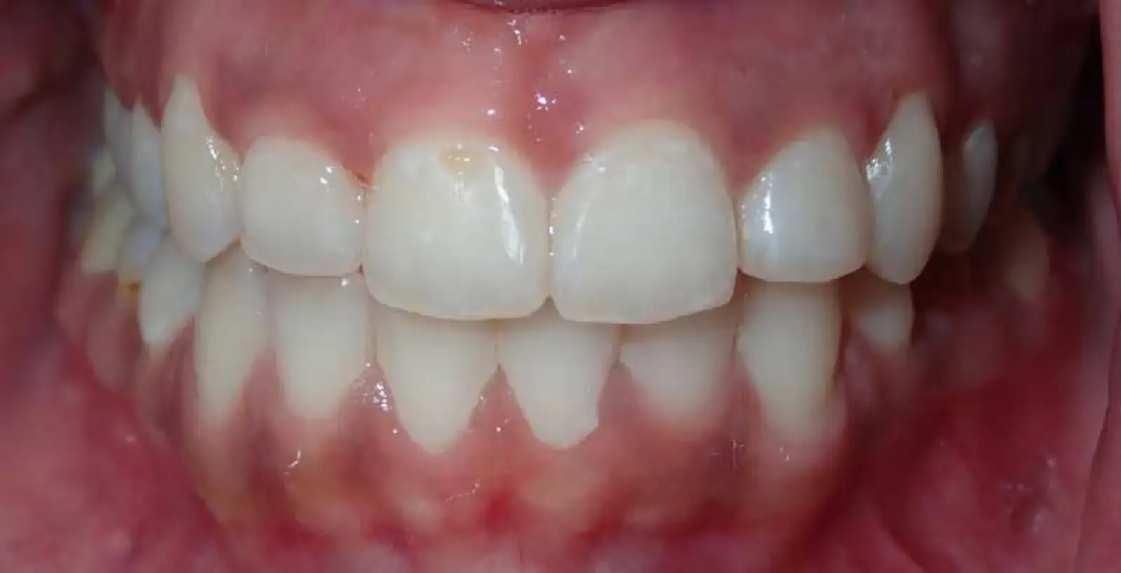 A close-up of a person's teeth and gums, showing some discoloration and inflammation of the gums.