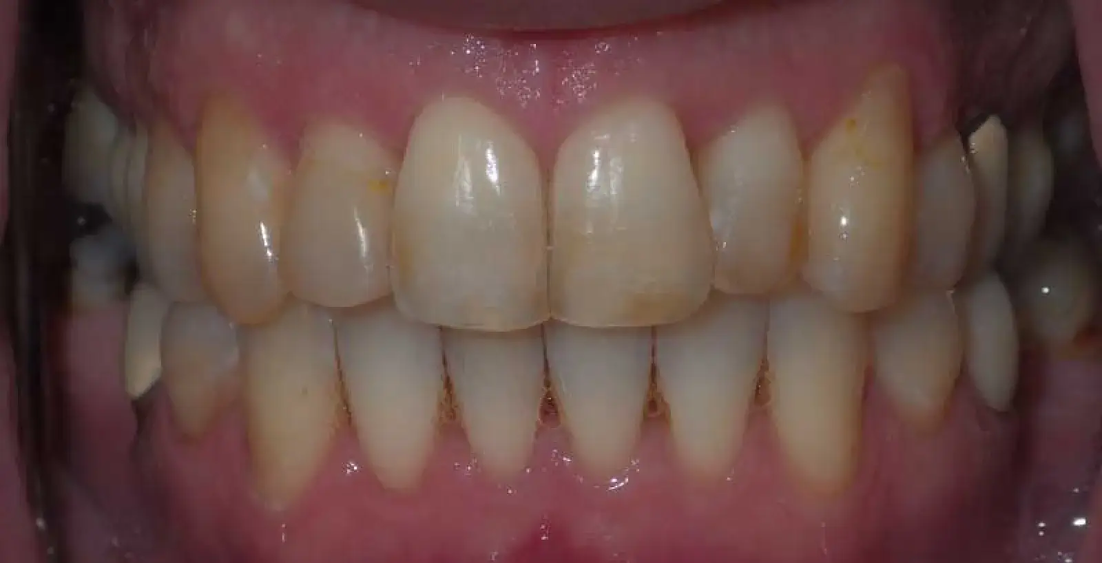 A close-up of aligned upper and lower teeth, showing healthy gums and clean teeth.