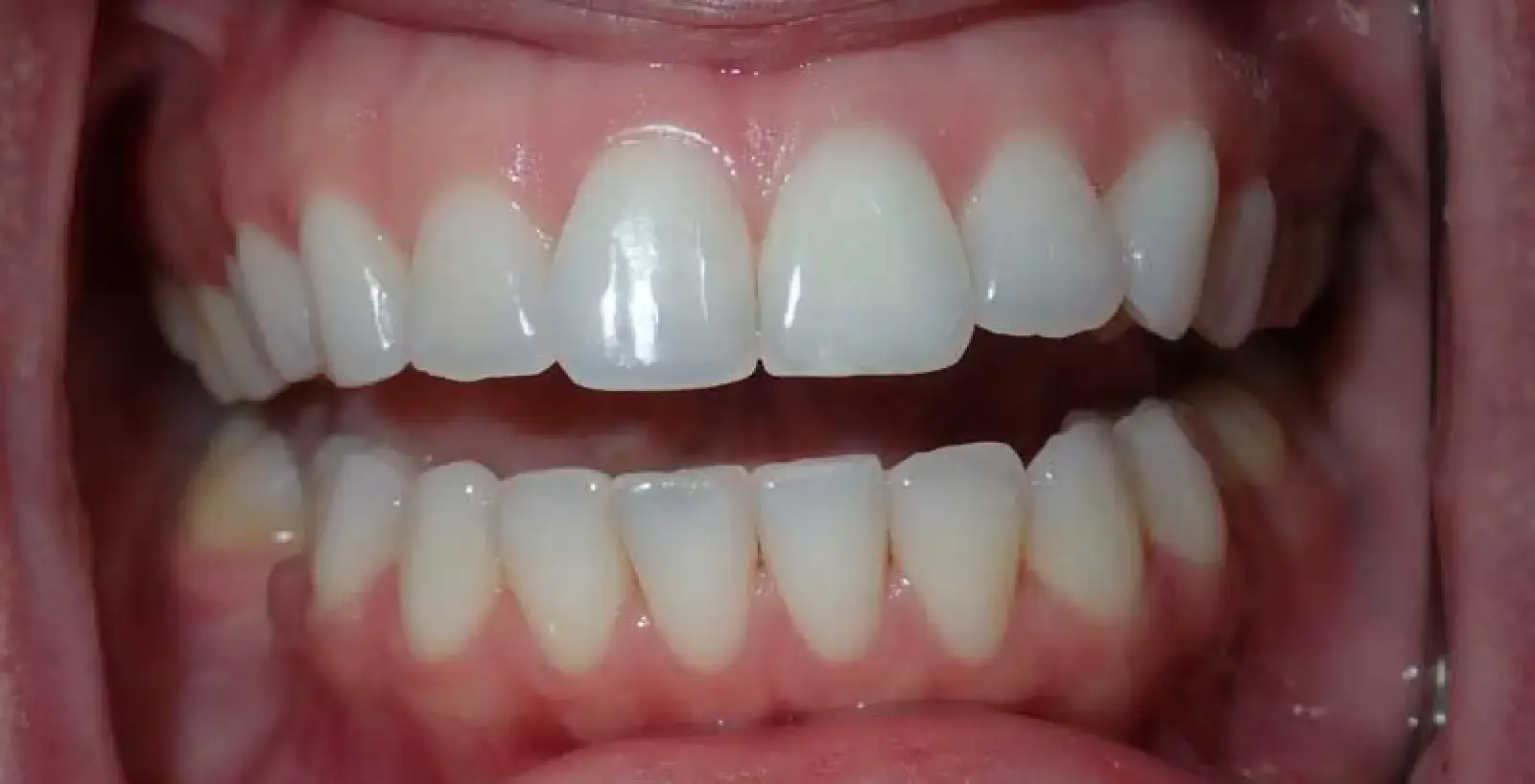 Close-up of a person's open mouth showing teeth and gums clearly.