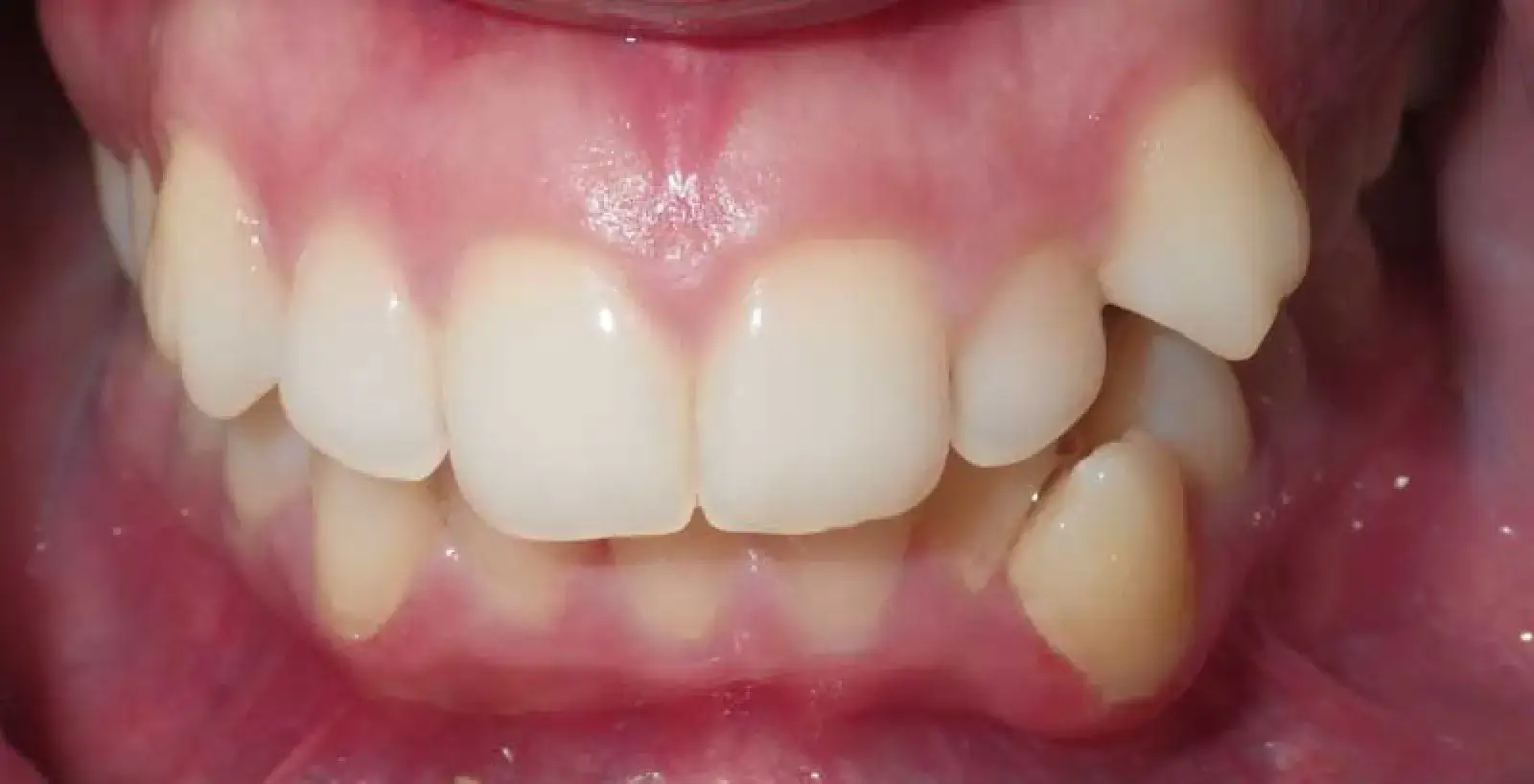 Close-up of human teeth showing crowded lower front teeth and a missing upper lateral incisor.