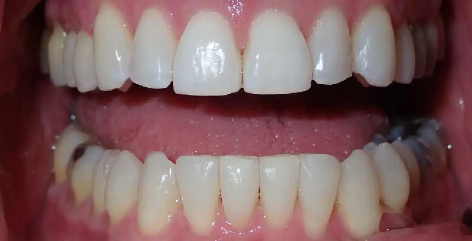 A close-up of a person's open mouth showing top and bottom teeth.