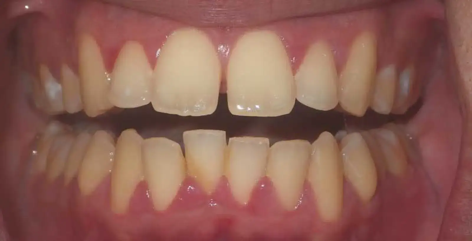 Close-up of a person's open mouth showing their teeth and gums.