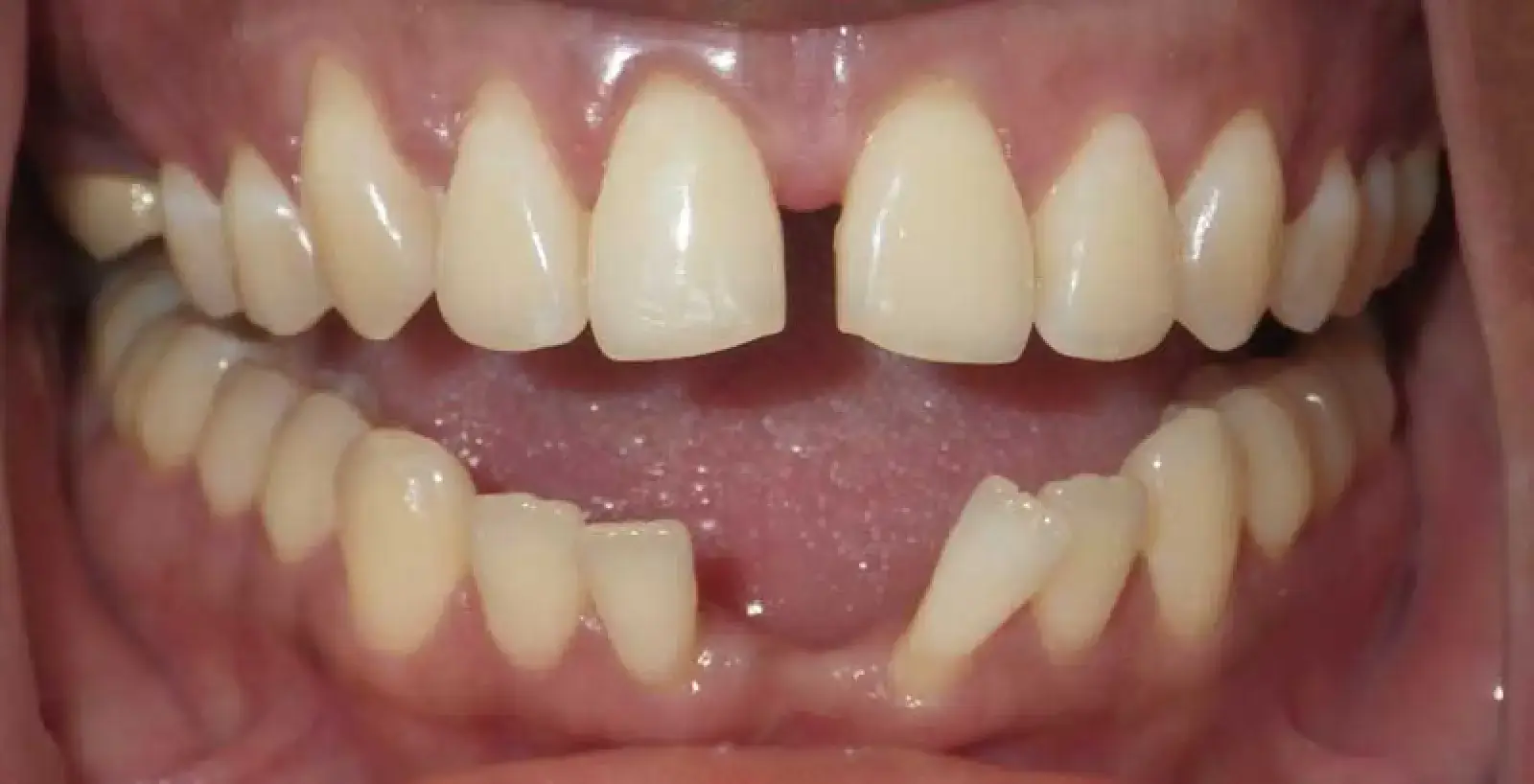 A close-up of a person's open mouth showing misaligned and uneven teeth.