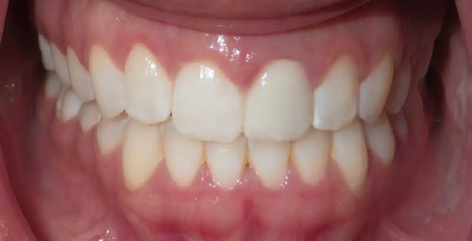 Close-up of a person's mouth showing straight, natural white teeth and pink gums.