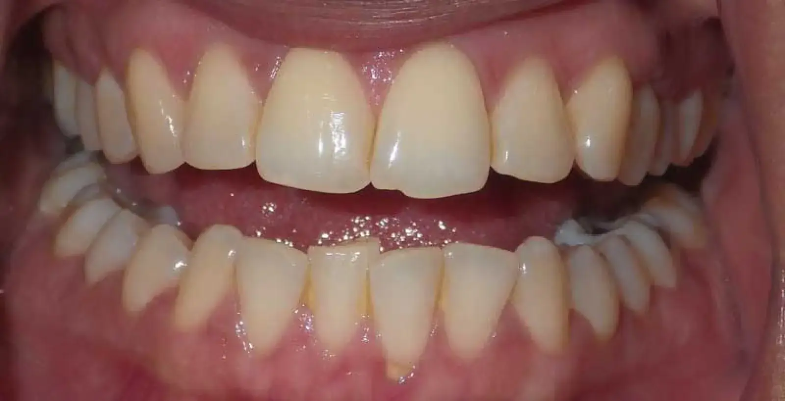 Close-up of a person’s open mouth showing teeth with some crowding and misalignment.