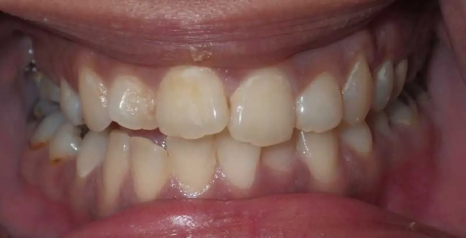 A close-up of slightly yellowed upper and lower teeth with some misalignment.