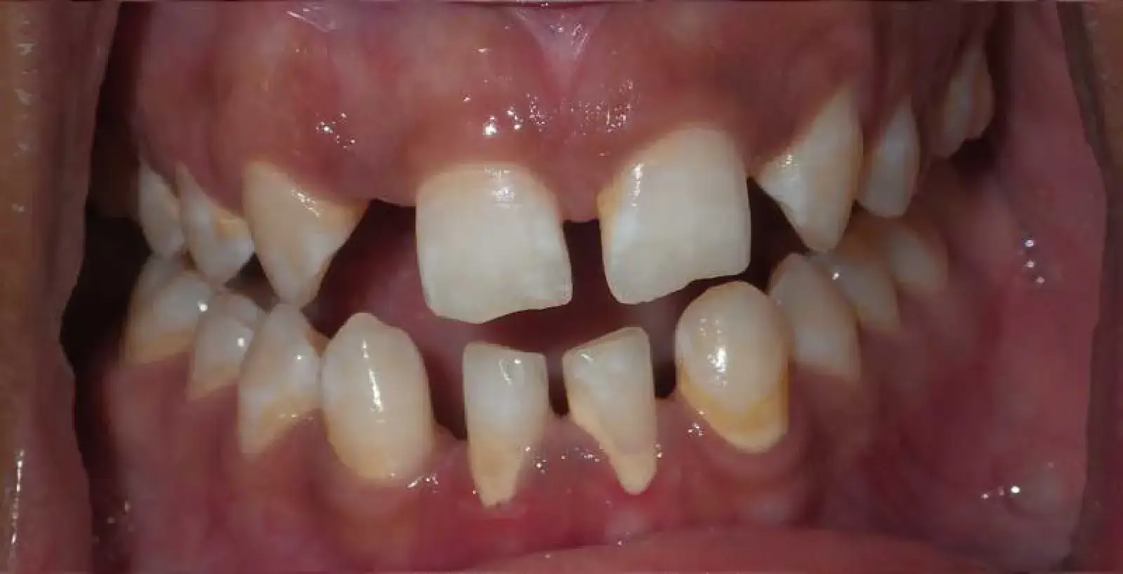 Close-up of a mouth showing misaligned teeth with gaps and plaque buildup on lower teeth.