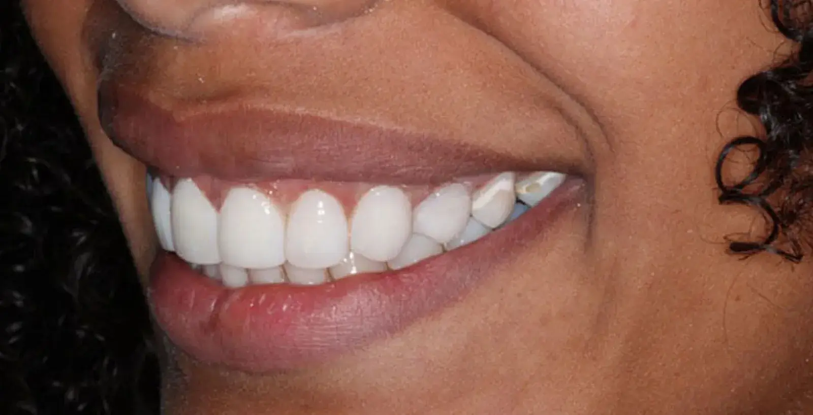 A person is smiling, showing clean, white teeth.