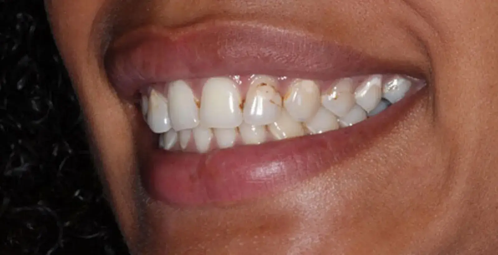 Close-up of a smiling person showing teeth with visible brown stains on the upper front teeth.