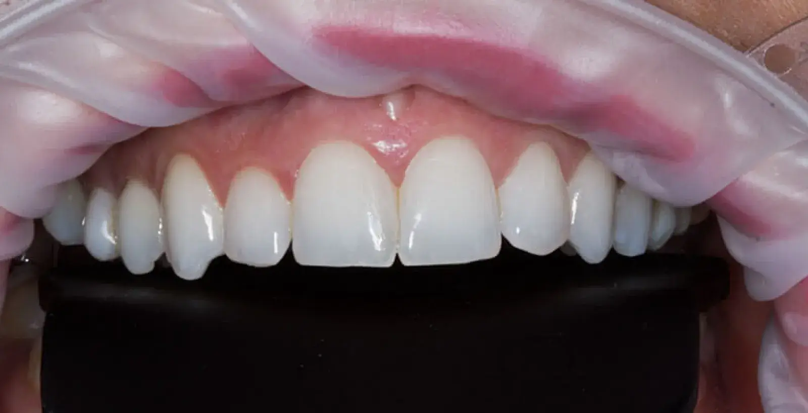 A close-up of a person's mouth showing a full set of straight, white teeth.