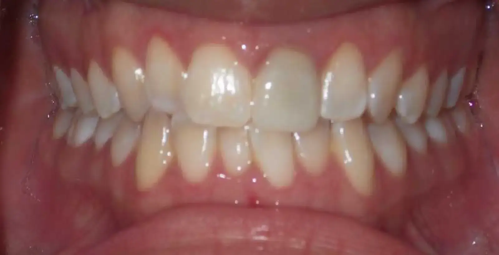 Close-up of an open mouth showing upper and lower teeth with mild misalignment.