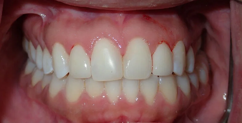 A close-up of a person smiling, showing upper and lower teeth.