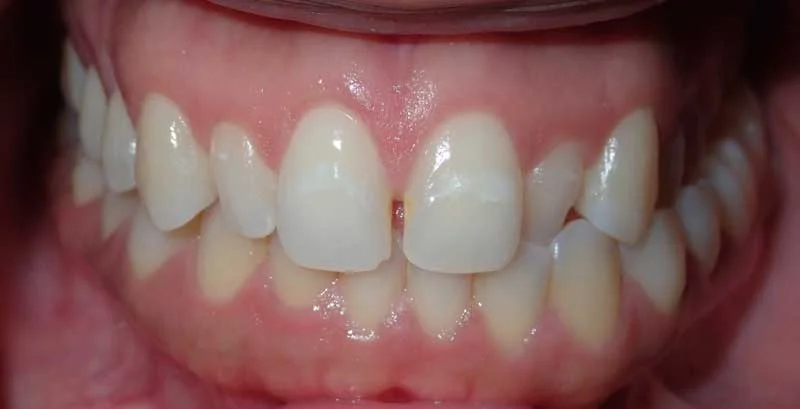 Close-up of a person's teeth showing an underbite, with the lower teeth overlapping the upper teeth.