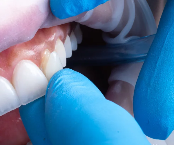Dentist examining a patient's gum and teeth with gloved hands.