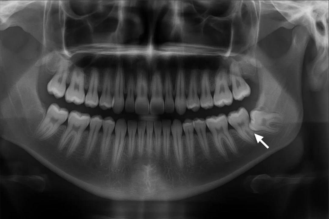 X-ray showing impacted wisdom tooth