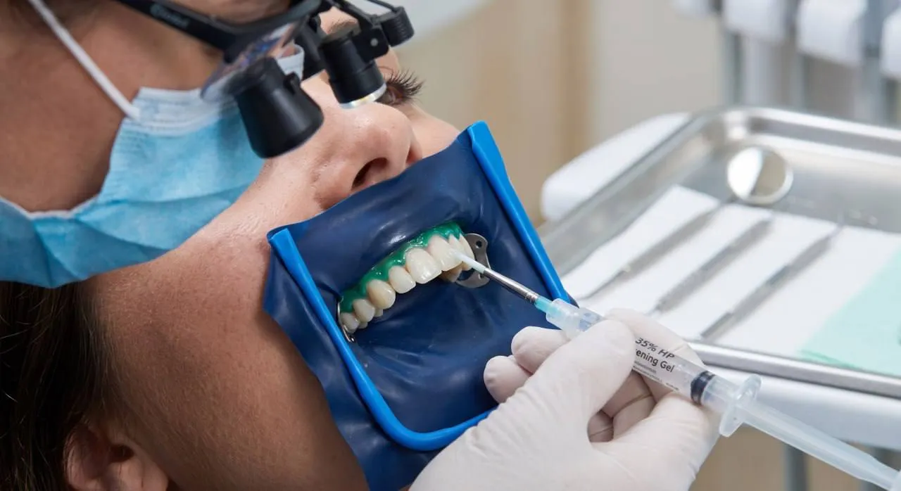 Whitening gel applied to protected teeth
