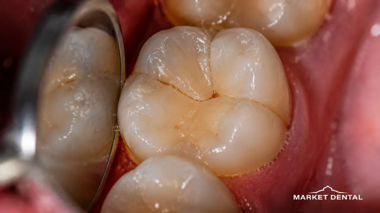 Close-up view of a tooth being examined for cavities