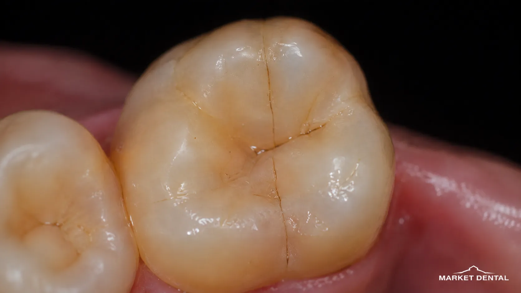 What Is a Cracked Tooth Types of Dental Fractures