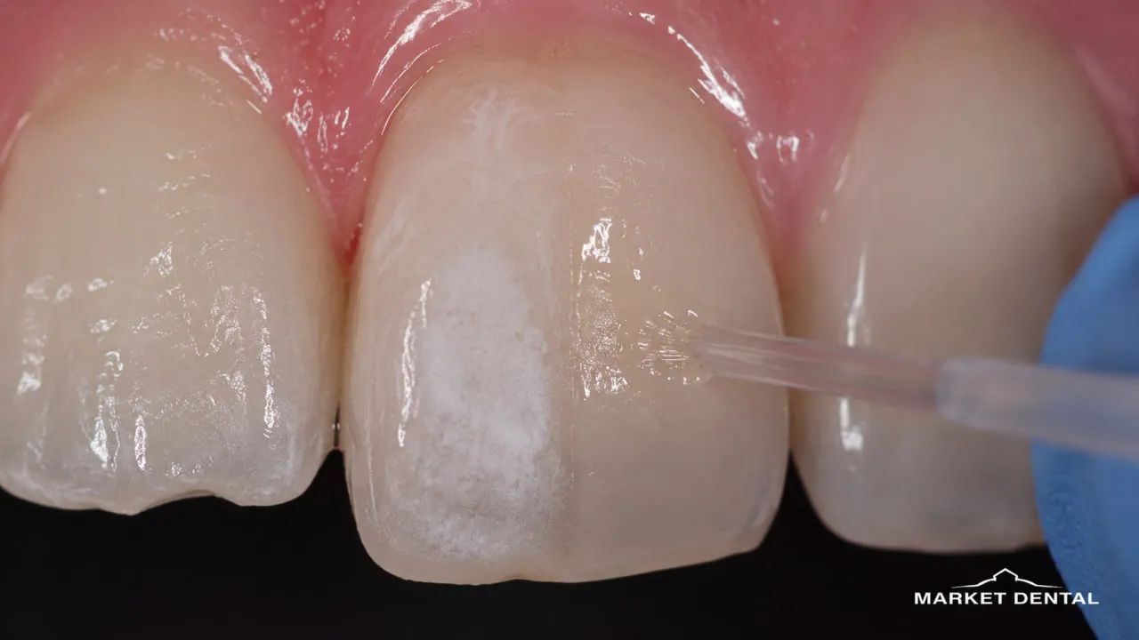 Resin Infiltration Can Reduce Contrast Without Treating Every White Mark the Same Way