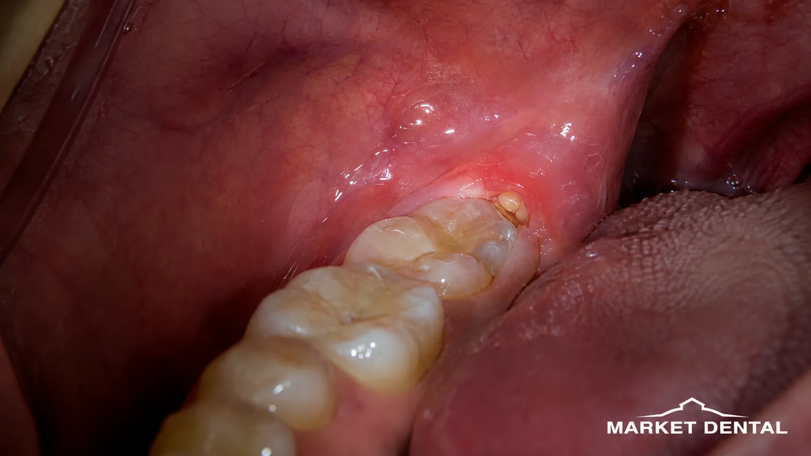Pericoronitis Can Keep Returning