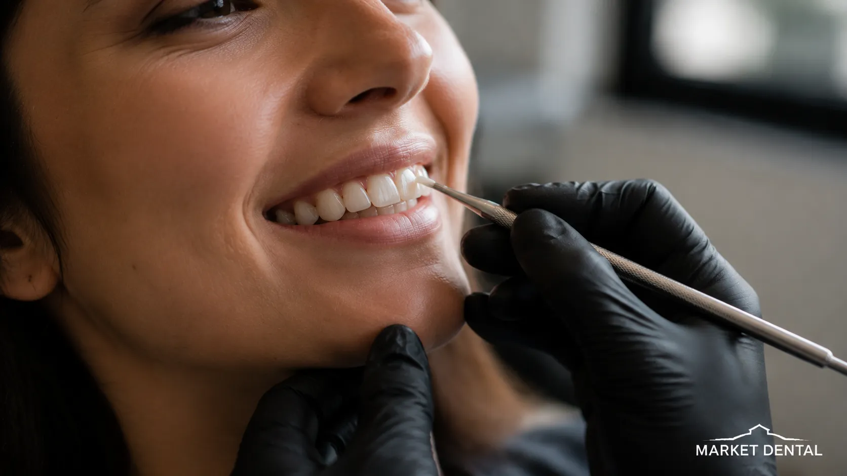 Dental Bonding vs Veneers How to Choose the Right Cosmetic Option