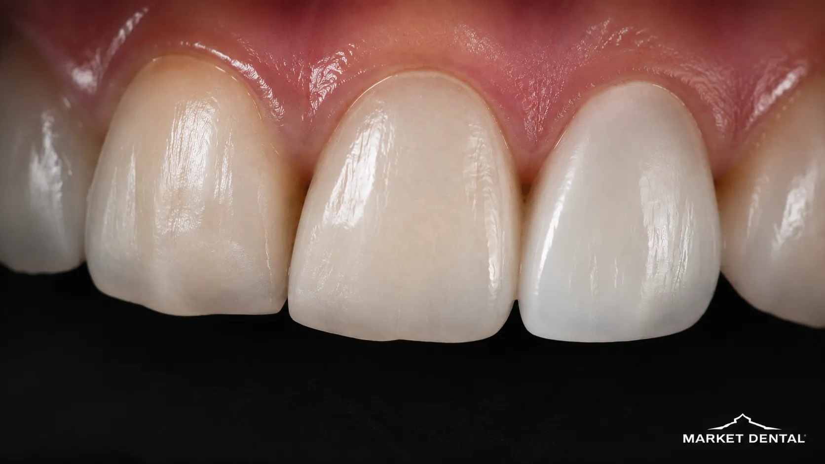 Three Options, Three Different Levels of Tooth Coverage