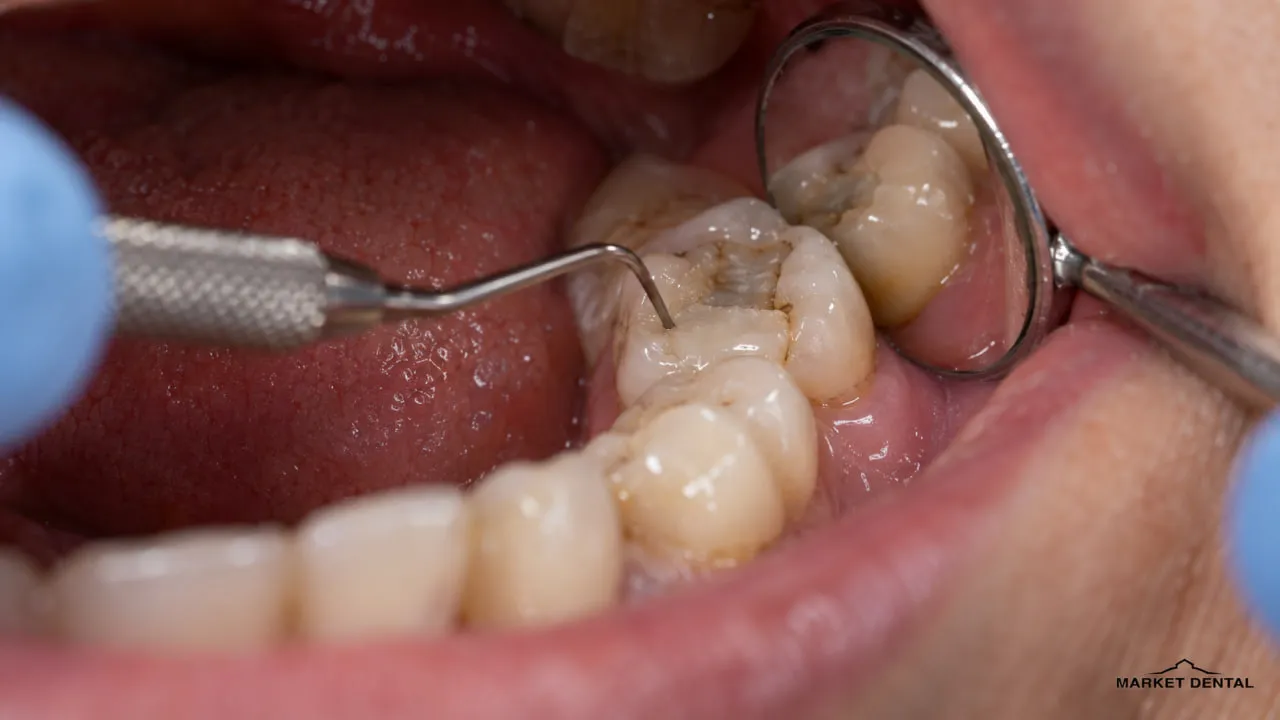 A Tooth Can Have Both Decay and a Crack