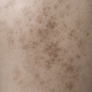 Close-up of skin showing sun damage and brown spots