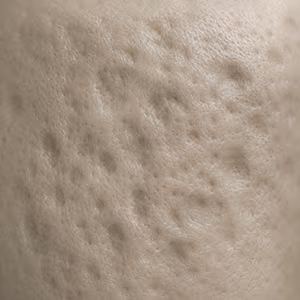 Close-up of skin showing acne scarring