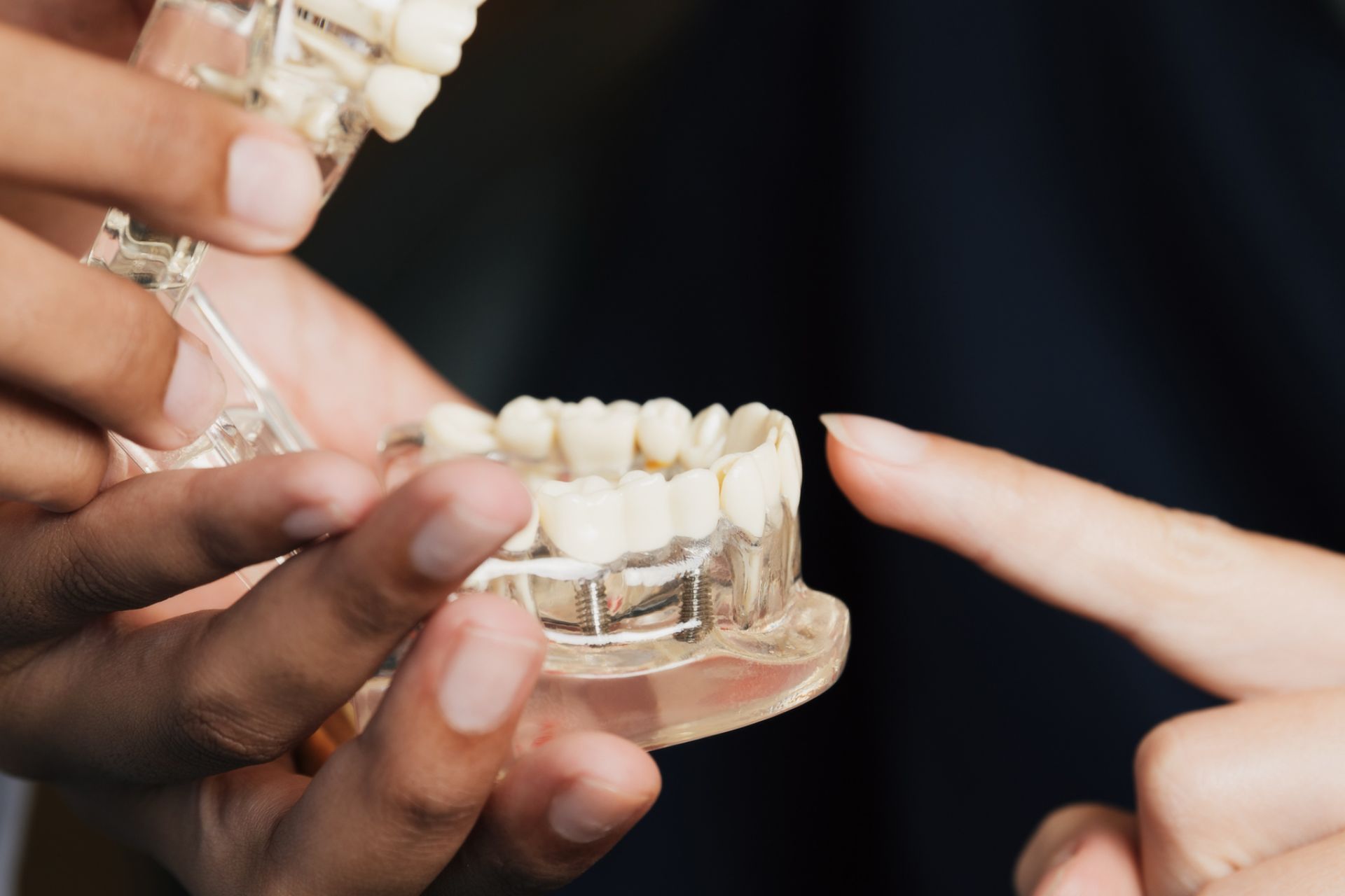 Two hands holding and pointing at a dental implant model with artificial teeth and screws.