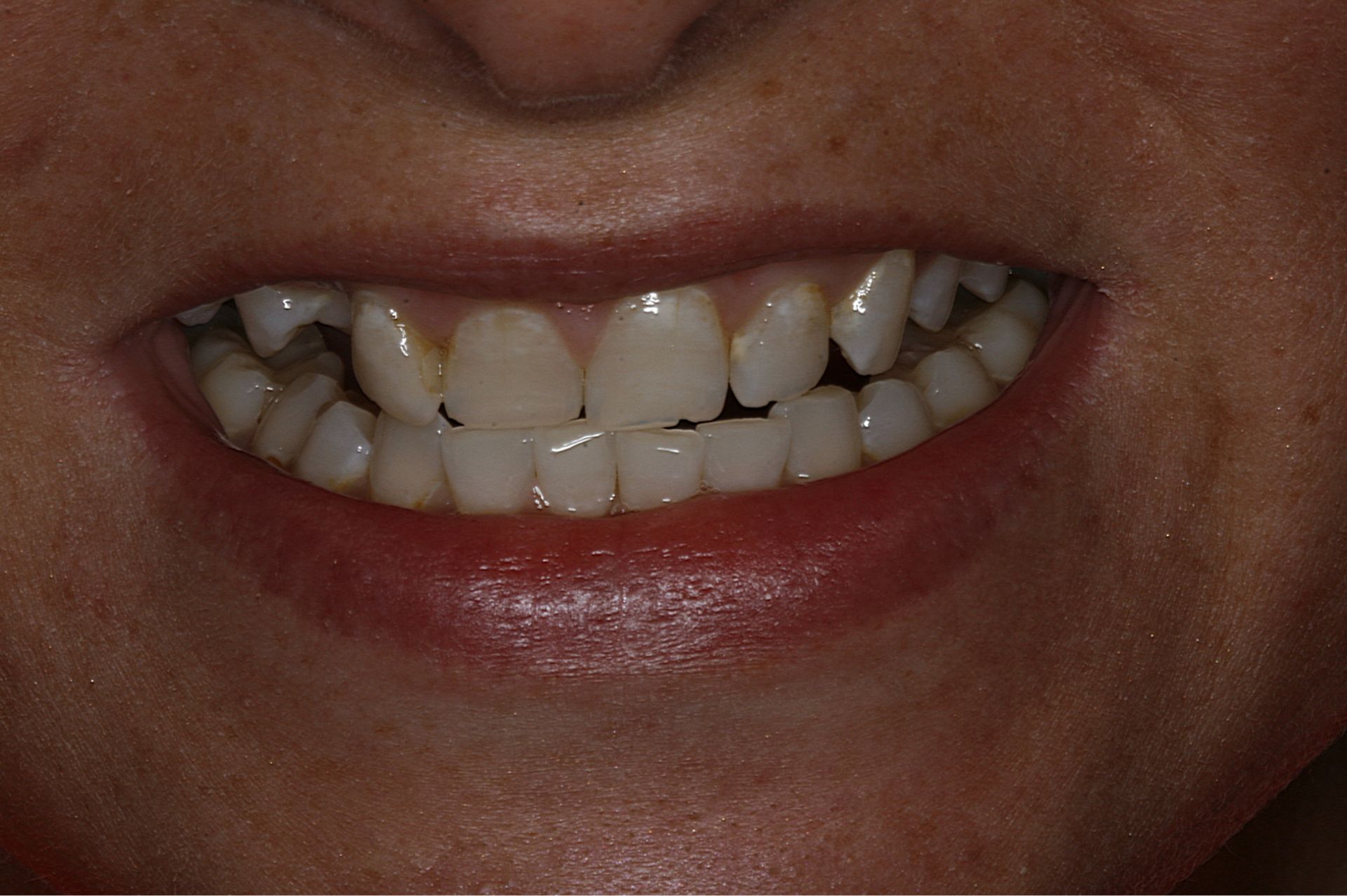Close-up of a person's smile showing uneven teeth with visible brown stains and discoloration.