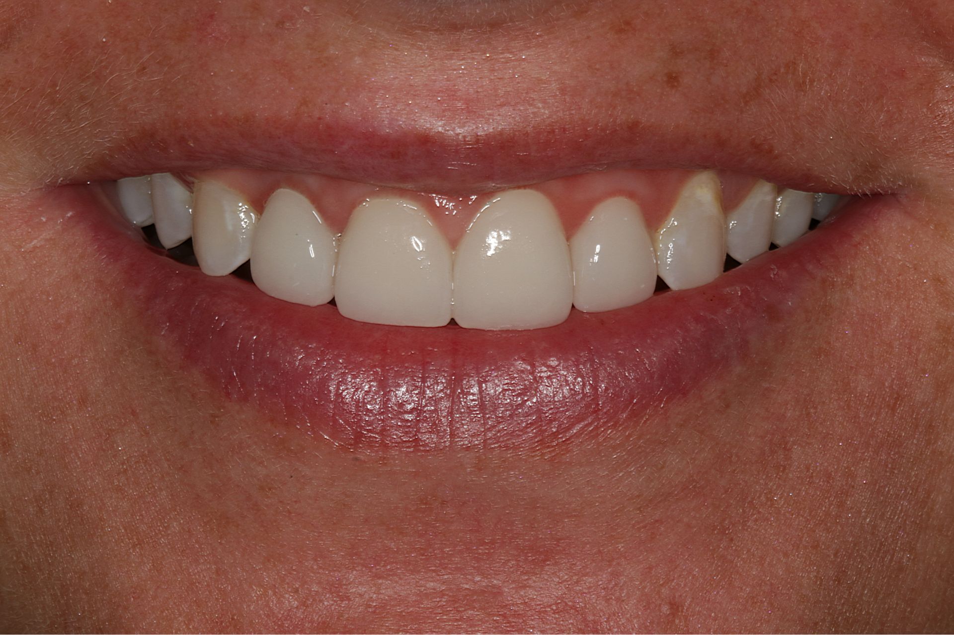 Close-up of a person's smiling mouth showing upper and lower teeth and lips.