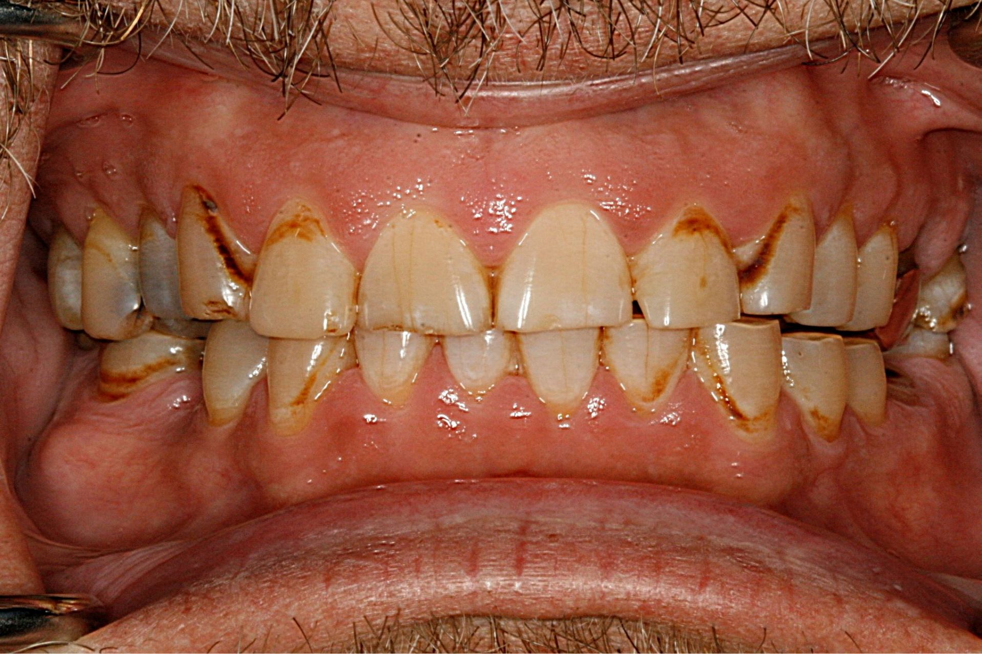 Close-up of teeth with brown stains and damage on upper and lower front teeth and gums.