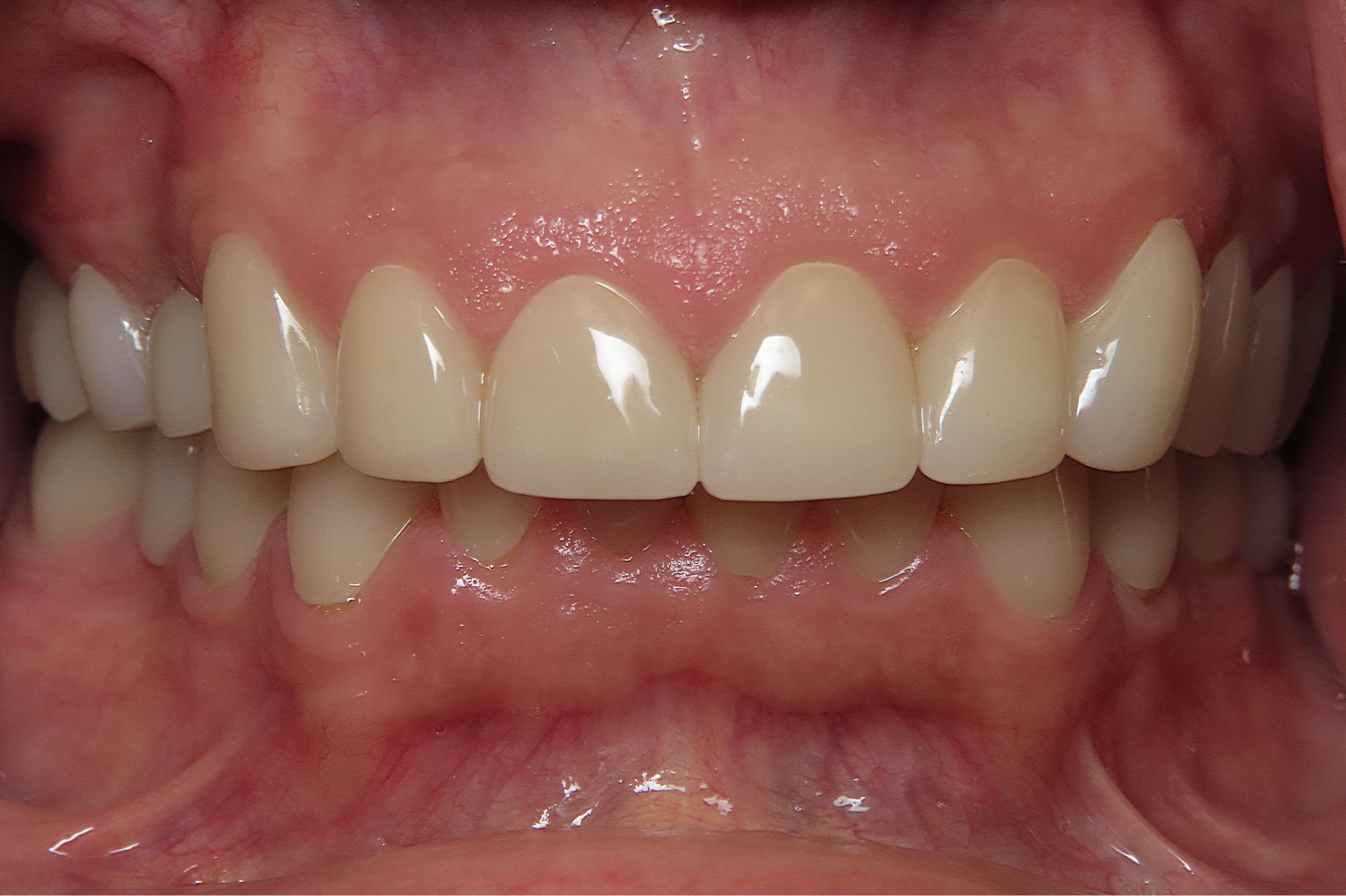 Close-up of upper and lower teeth with gums visible and teeth slightly apart.