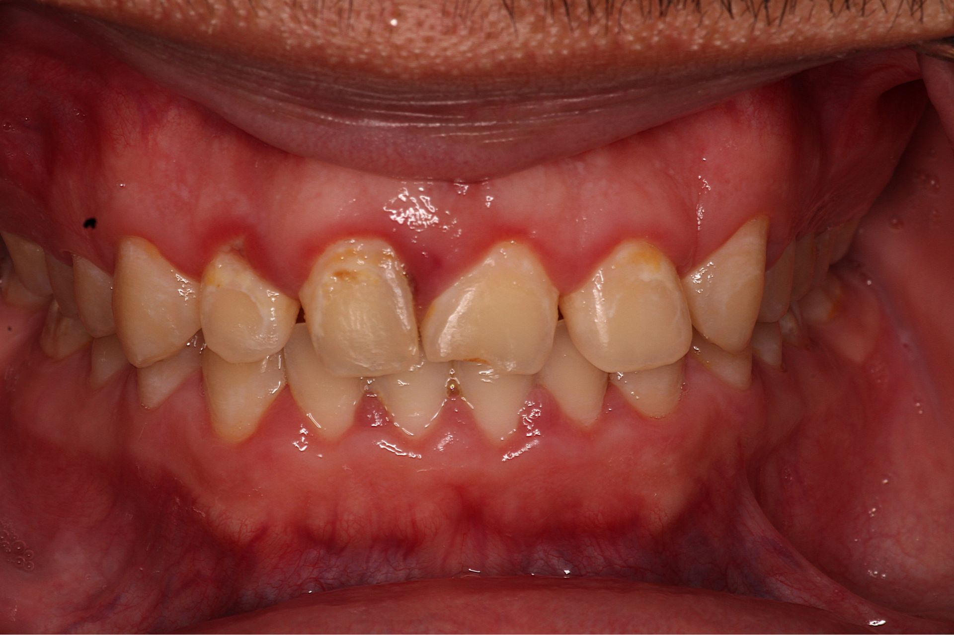 Close-up of teeth with enamel erosion and gum inflammation on upper and lower front teeth.