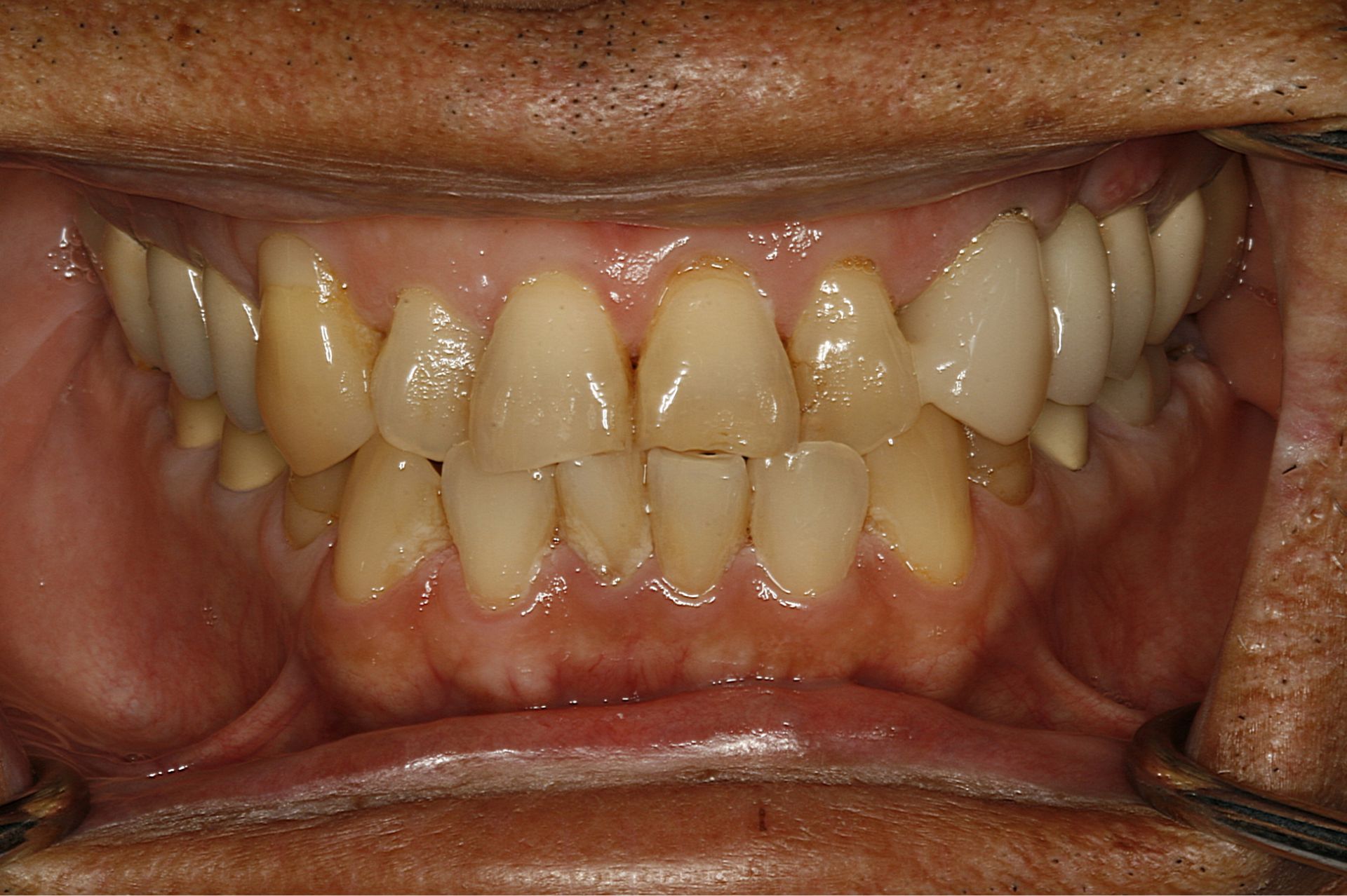 Close-up of stained, worn human teeth with visible plaque and dental issues.