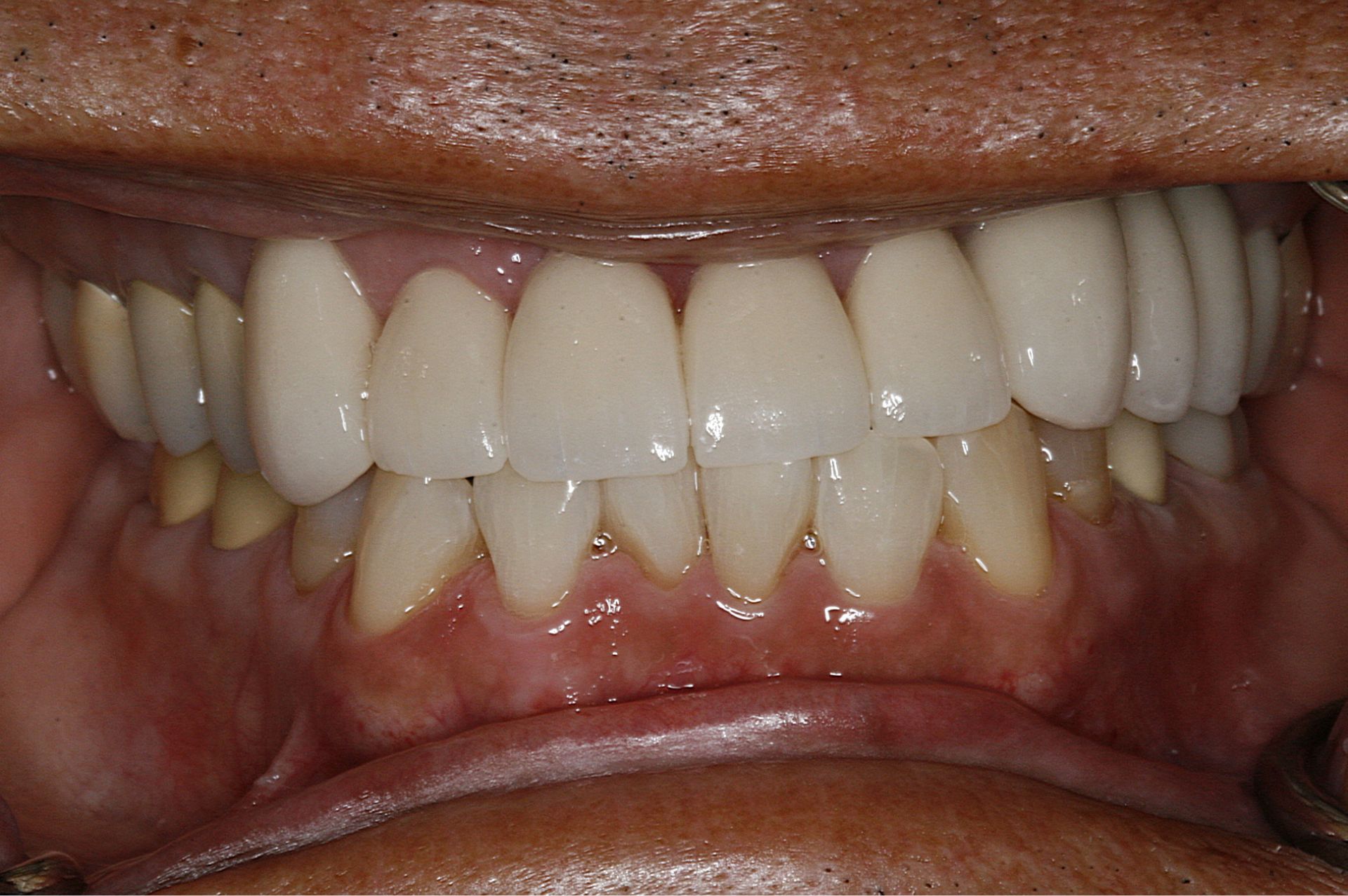 Close-up of a person’s teeth showing a full set of upper dental crowns and natural lower teeth.