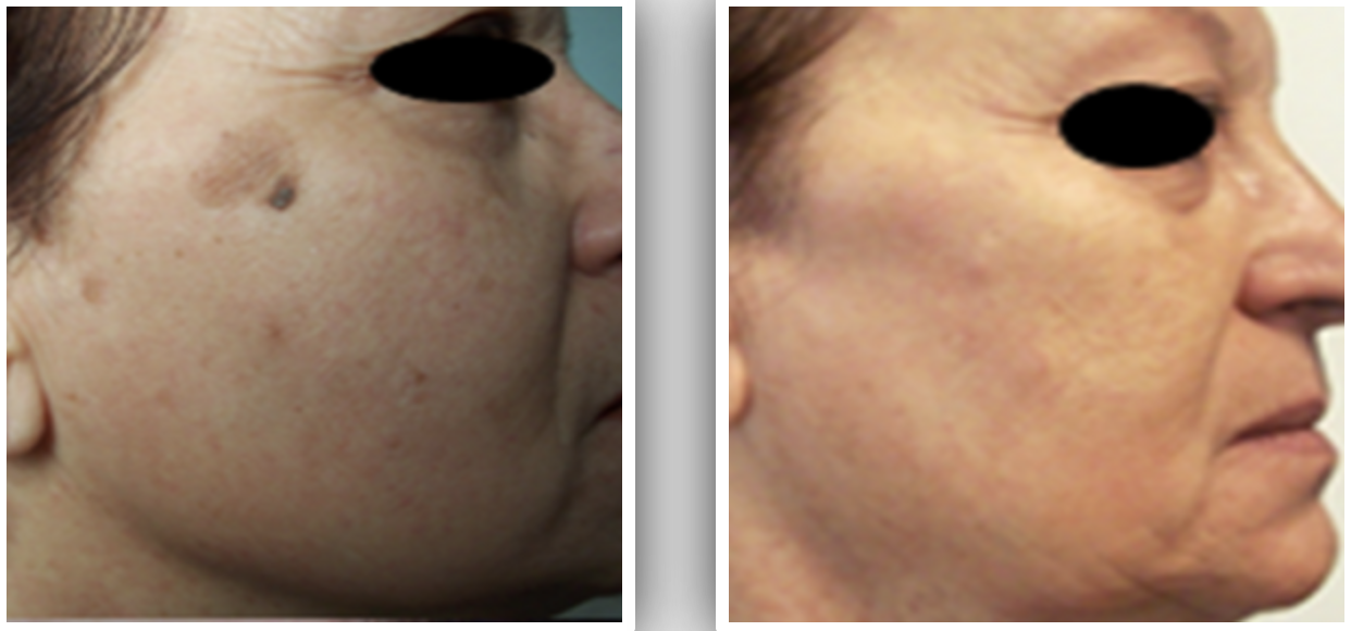 Side-by-side before and after close-up photos of an older woman’s cheek showing reduced dark spots and smoother skin in the second image.