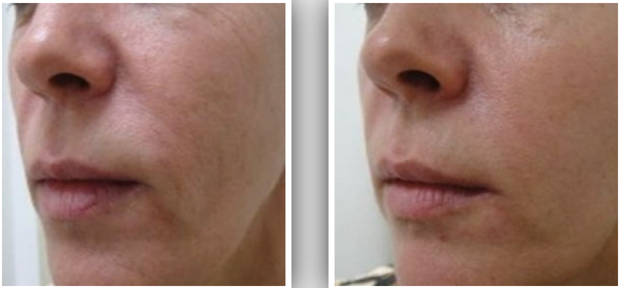 Side-by-side close-up comparison of a person's lower face showing reduced wrinkles and smoother skin texture on the right.