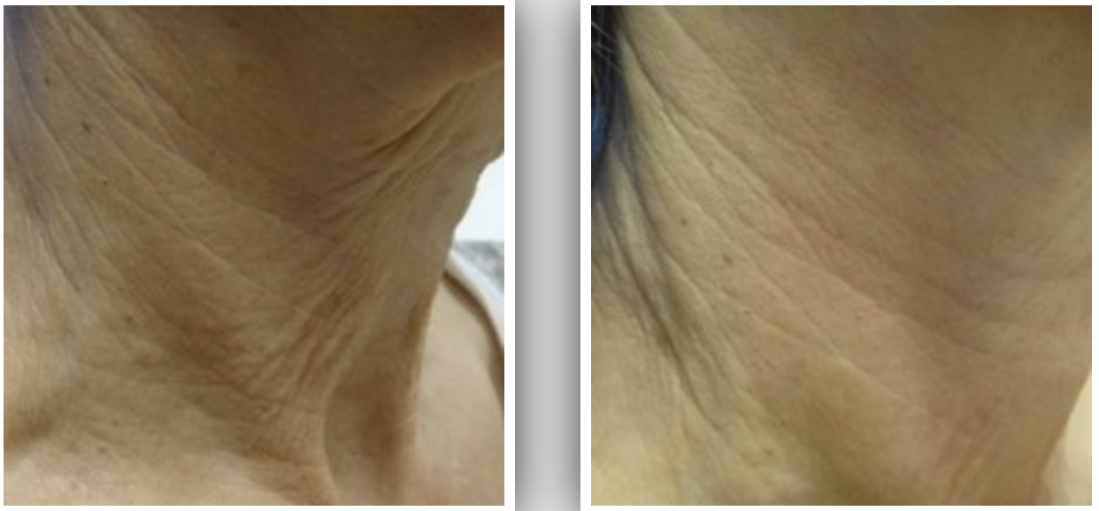 Side-by-side close-up comparison of an older person's neck showing visible wrinkles and improved skin texture with reduced wrinkles.