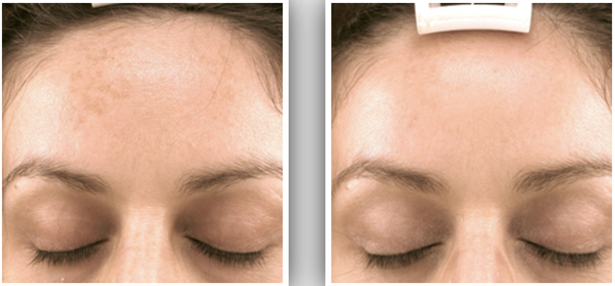 Close-up comparison of a person's forehead before and after treatment, showing reduced dark spots and smoother skin in the after image.