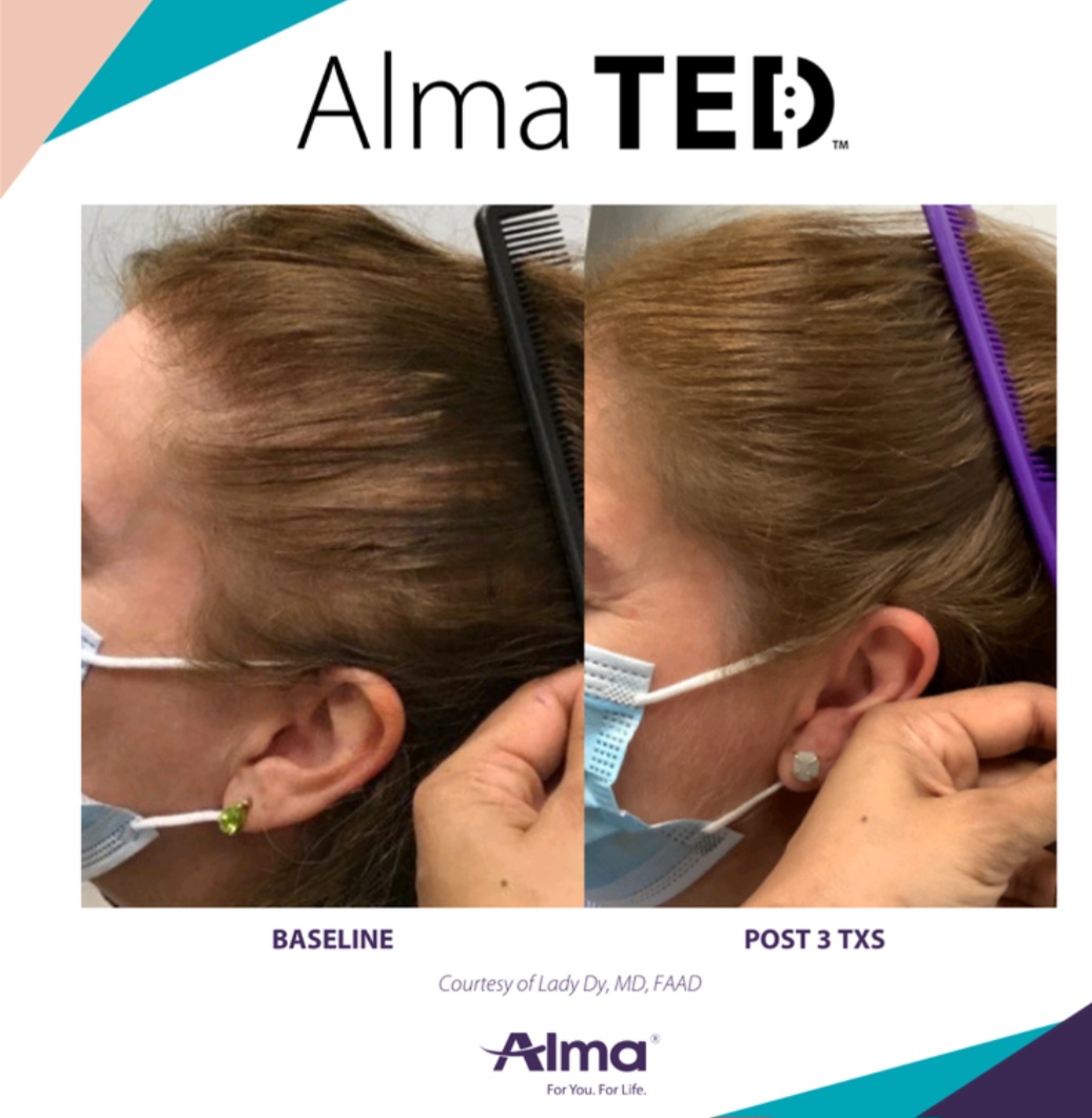 Side-by-side comparison of a woman's scalp before and after three treatments, showing increased hair density in the after image.