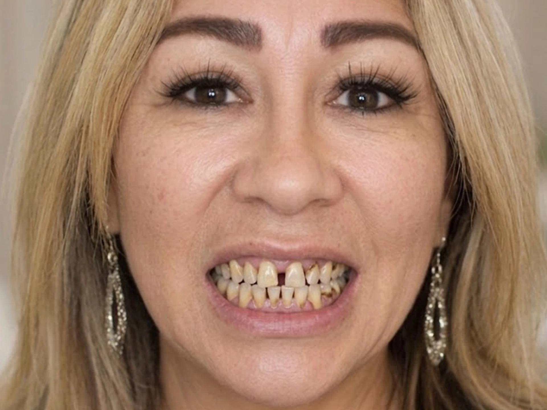 Close-up of a woman showing severely decayed and discolored teeth.