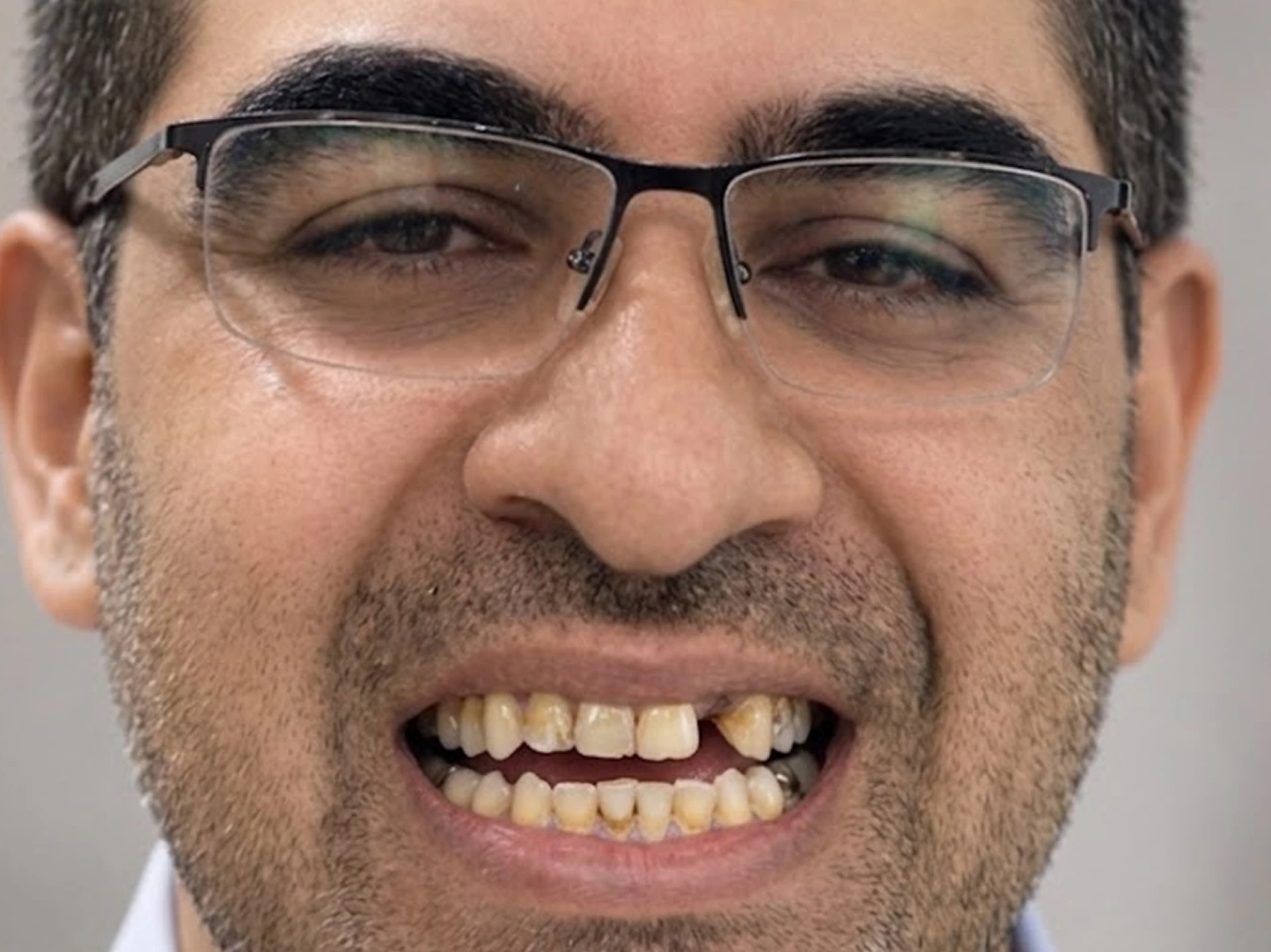Close-up of a man with glasses smiling showing uneven and stained teeth.
