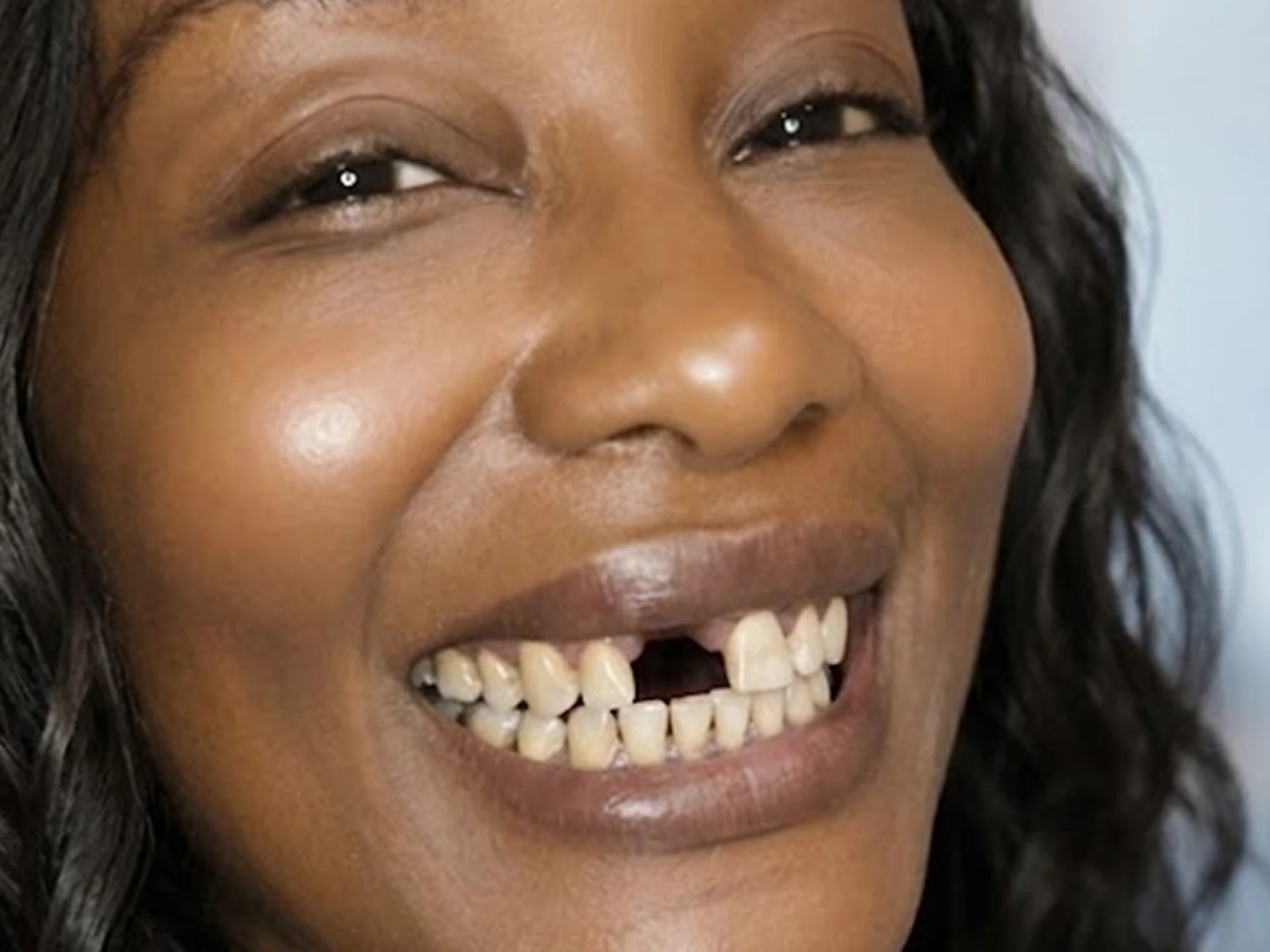 Close-up of a smiling woman with dark skin showing a missing front tooth.