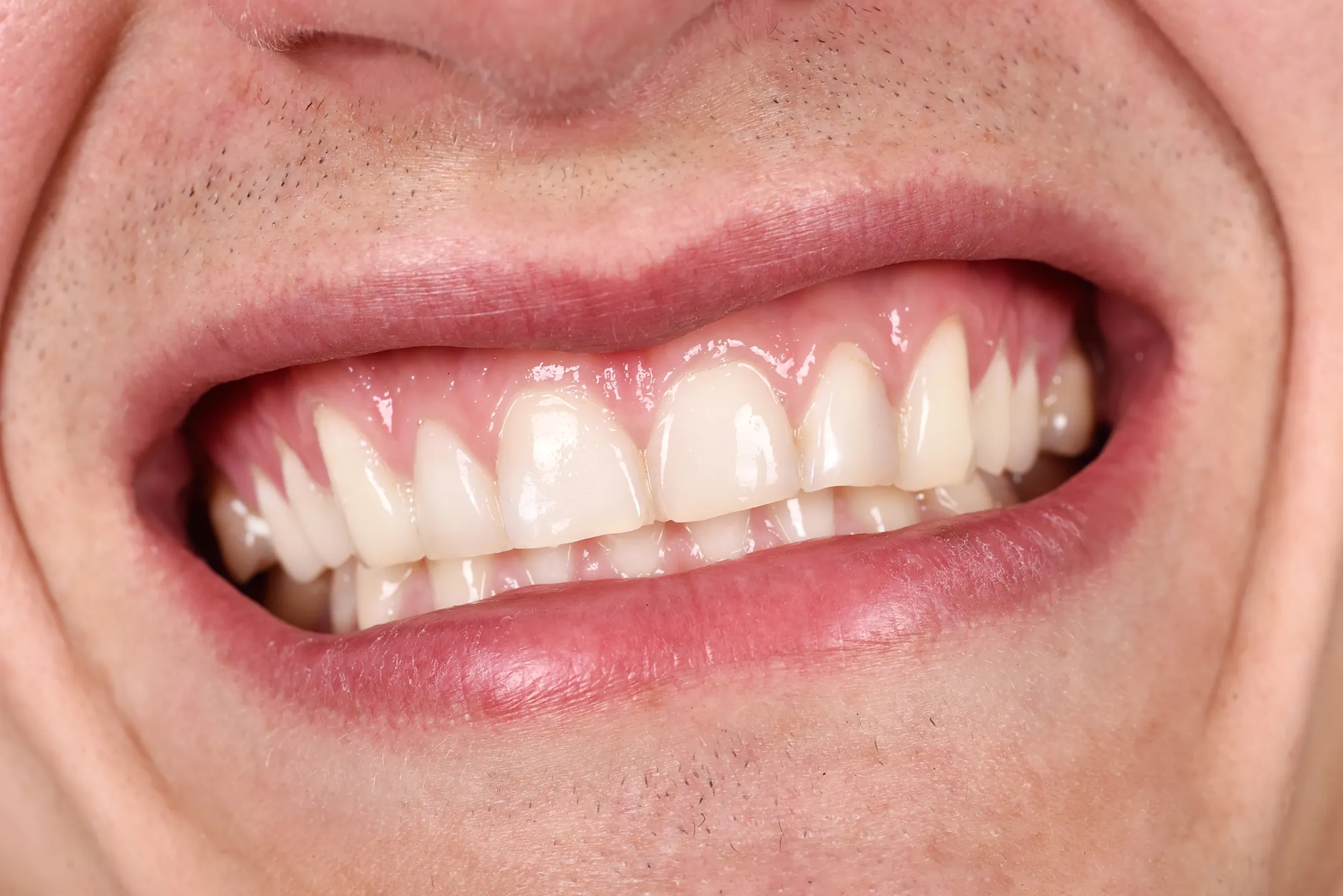 Gummy Smile Treatment / Crown Lengthening