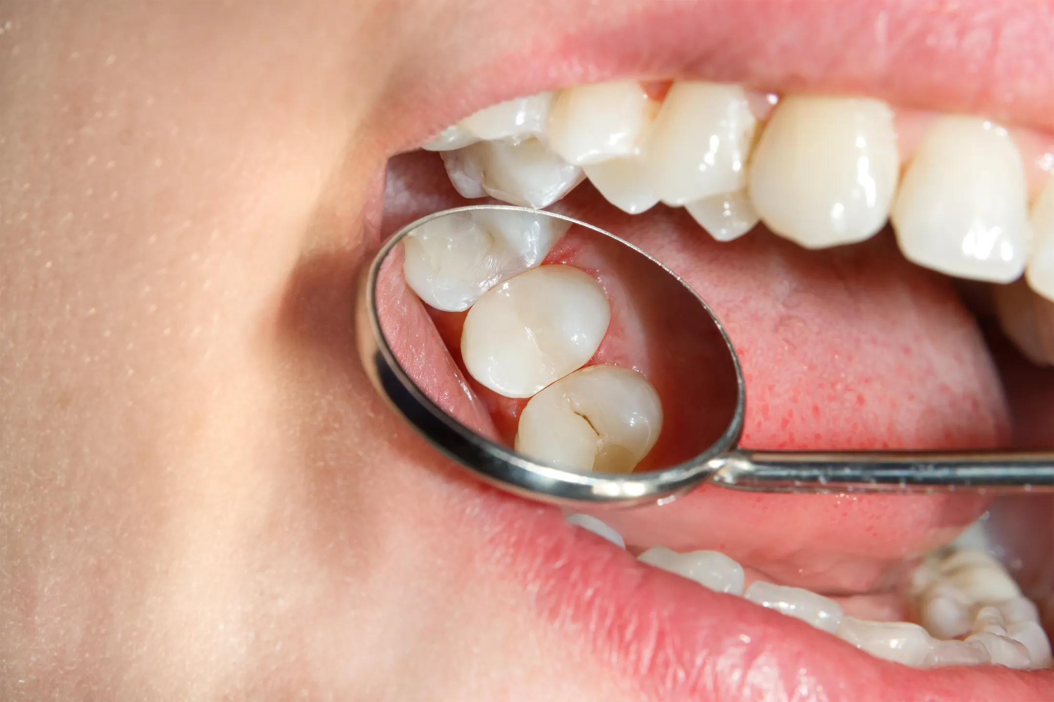 Fluoride Treatments / Sealants