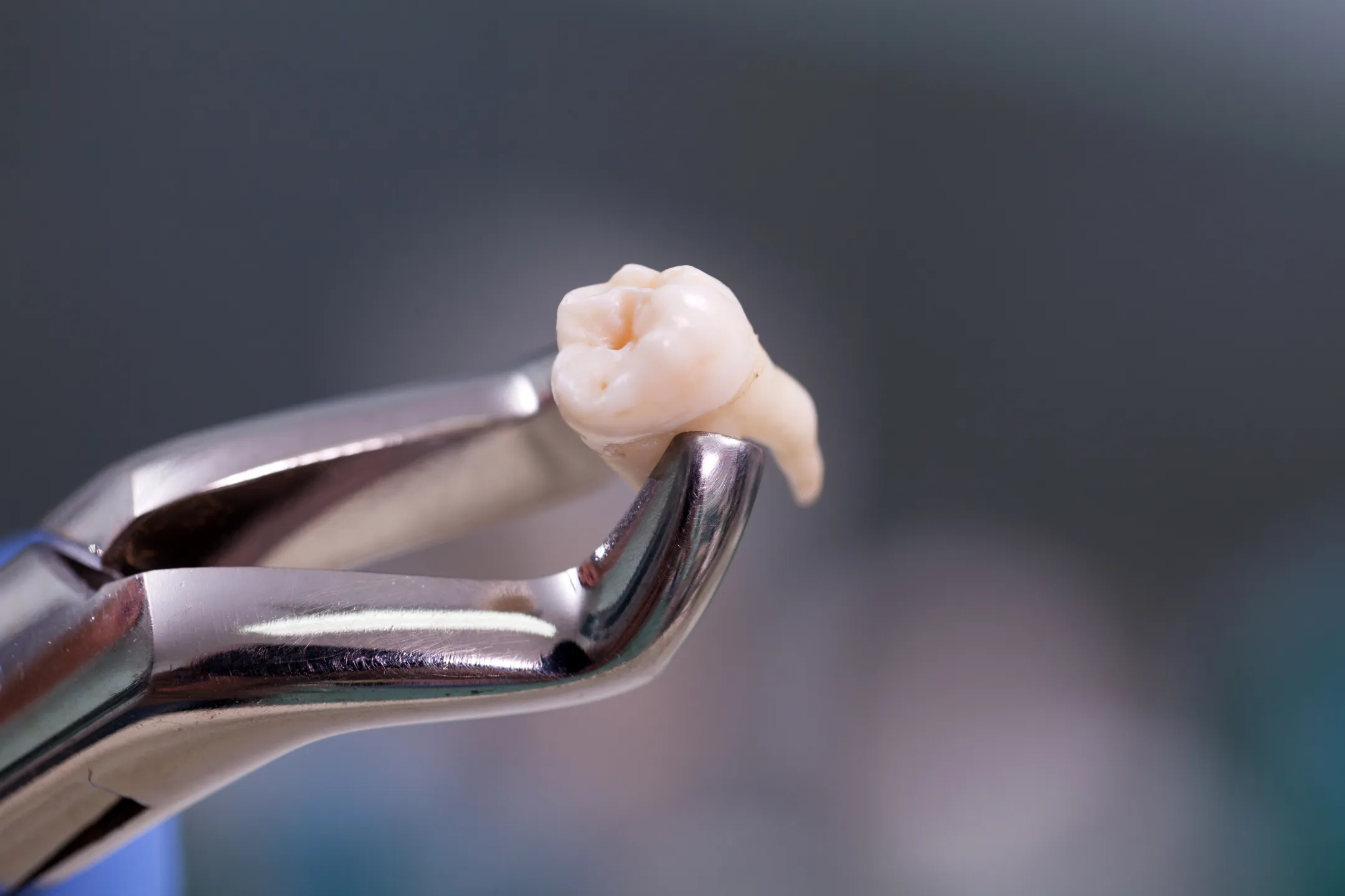 Wisdom Teeth Removal / Tooth Extractions