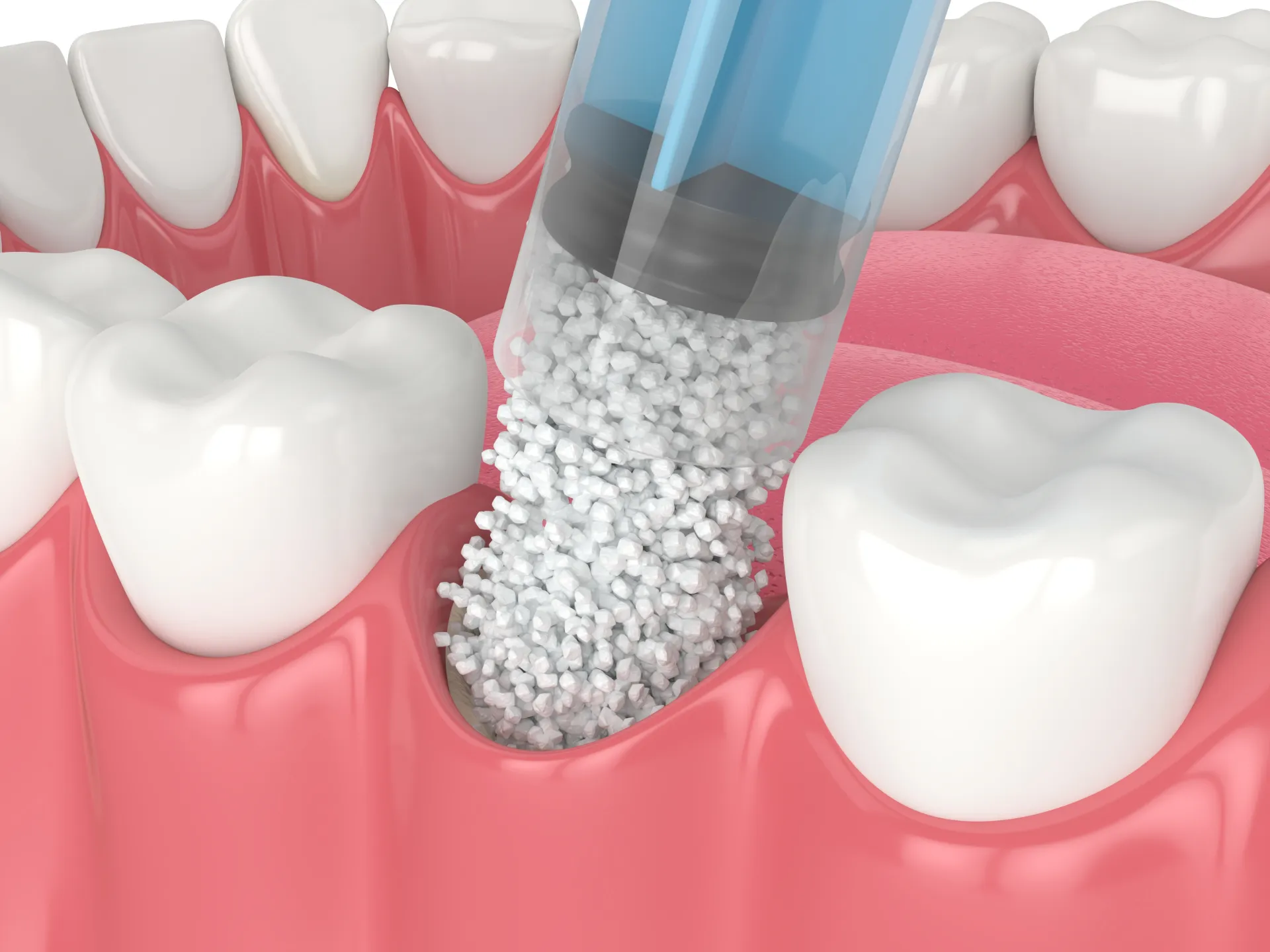 Bone Grafting & Ridge Augmentation